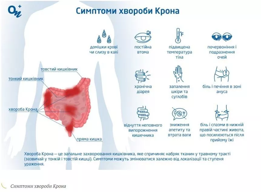 Приклад зображення для сторінки послуги «Лікування хвороби Крона»